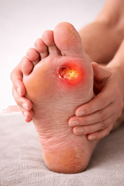 Diabetic Foot